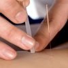 Acupuncture Be the best you can be, with Traditional Chinese Acupuncture, Chinese Herbal Medicine, Tui Na and Moxibustion