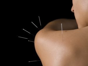Acupuncture - Shoulder