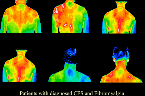 Fibromayalgia and CFS Medical Thermography