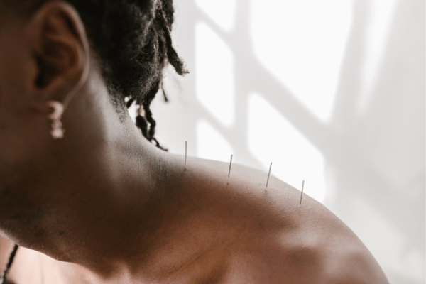 A practitioner performs acupuncture on a patient's back to alleviate pain, with needles inserted at specific points.